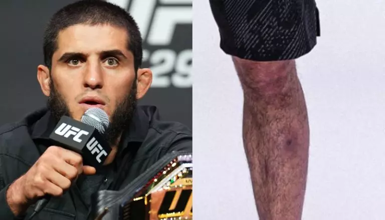 Islam Makachevs Leg Allegedly With A Staph Infection